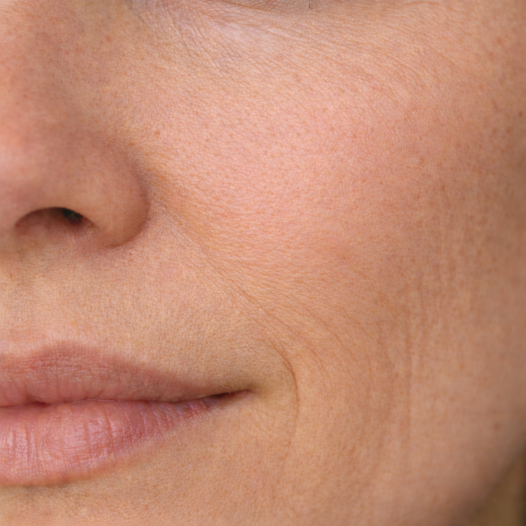 Arrugas & Lineas de Expresion